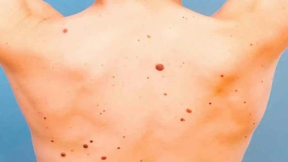 Ung thư biểu mô tế bào đáy thường xuất hiện ở những vùng da tiếp xúc nhiều với ánh nắng, như đầu và mặt.