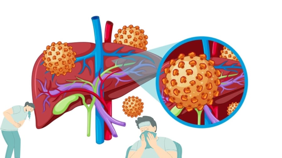 Việt Nam có tỷ lệ người mang virus viêm gan B cao
