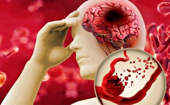 Những cơn tức giận hoặc căng thẳng đột ngột khiến cơ thể giải phóng một lượng lớn adrenaline, đẩy huyết áp tăng vọt.