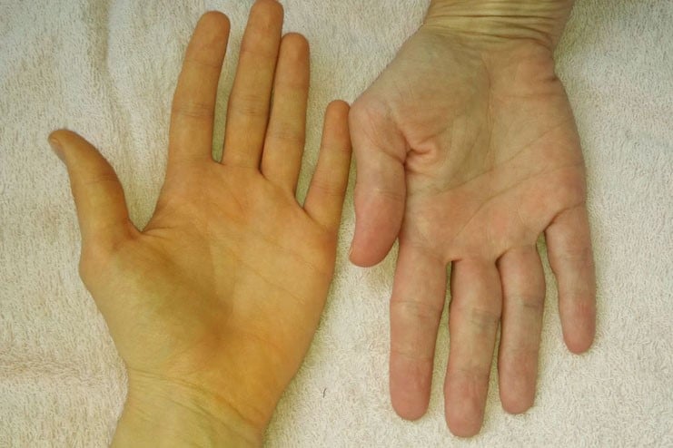 Dấu hiệu bệnh gan đi vào giai đoạn nặng