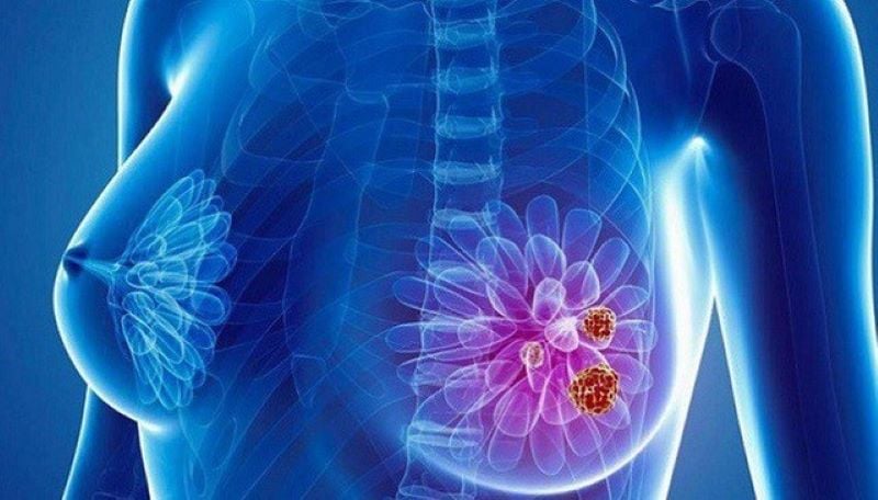 2 thói quen cực xấu của chồng khiến vợ dễ mắc ung thư vú, bỏ ngay kẻo ân hận cả đời