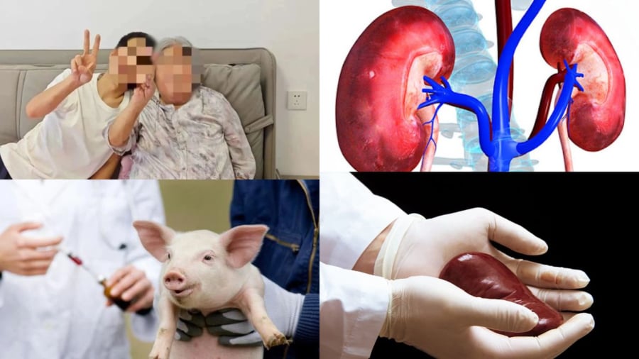 Ca ghép thận lợn biến đổi gene lên người tại Trung Quốc đã giúp bệnh nhân sống hơn 200 ngày