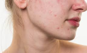 Chế độ ăn nhiều dầu mỡ, đồ chiên rán, ngọt hoặc cay nóng sẽ kích thích tuyến bã nhờn hoạt động mạnh hơn