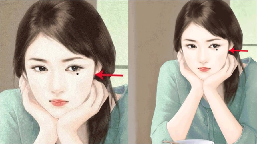 Những nốt ruồi may mắn giàu có