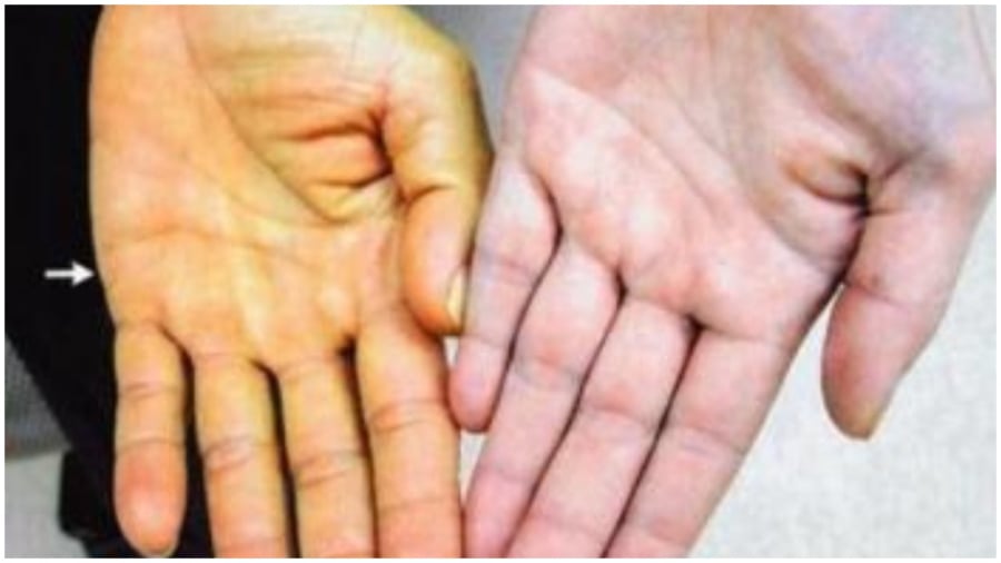 Những dấu hiệu cảnh báo bệnh gan nghiêm trọng