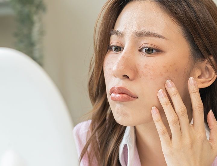  Các sản phẩm có chứa hydroquinone, retinoids, axit kojic, axit azelaic hoặc vitamin C có thể giúp ức chế sản xuất melanin