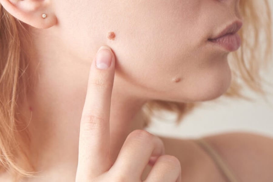 Một nốt ruồi mới xuất hiện, hoặc nốt cũ thay đổi nhanh về màu sắc, kích thước, hình dạng – chính là tín hiệu cảnh báo sớm ung thư da.    