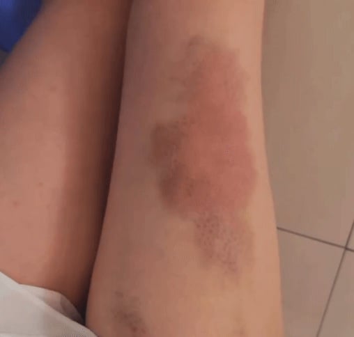  Tiểu Vy lộ đôi chân bầm tím khiến fan lo lắng