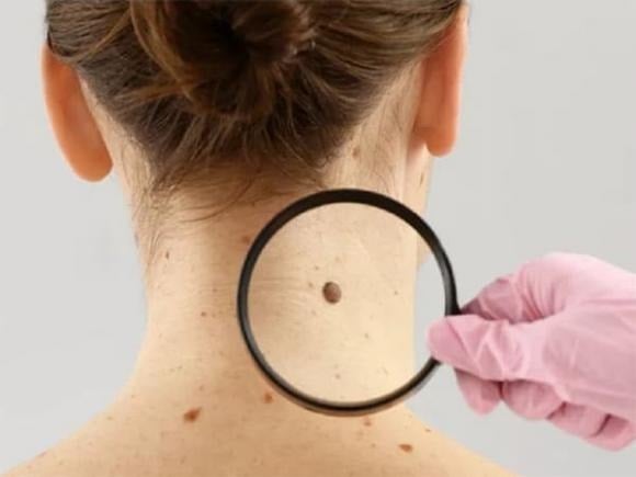 Đa số nốt ruồi đều lành tính, nhưng nếu nốt ruồi trở nên sẫm màu hơn, chuyển sang màu đen hoặc có sắc tố tối bất thường, đây có thể là dấu hiệu cảnh báo ung thư da, đặc biệt là u hắc tố ác tính.    