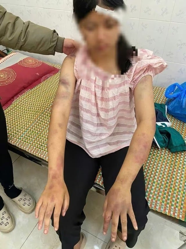 Trước đó, trên mạng xã hội Facebook xuất hiện bài đăng kèm hình ảnh tố cáo bé gái bị chính người nhà đánh đến mức phải nhập viện.