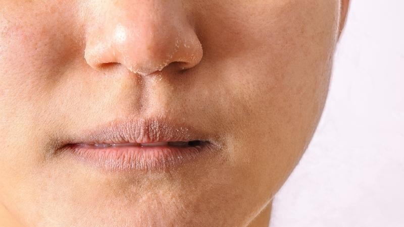 Ở mức độ nặng hơn, da có thể xuất hiện các mảng đỏ, sẩn nhỏ hoặc các vùng viêm nhẹ.