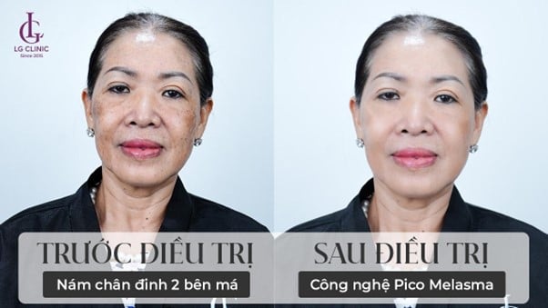 Kết quả điều trị thực tế được khách hàng chia sẻ sau 1 liệu trình điều trị nám chuyên sâu theo phác đồ Pico Melasma 12 bước