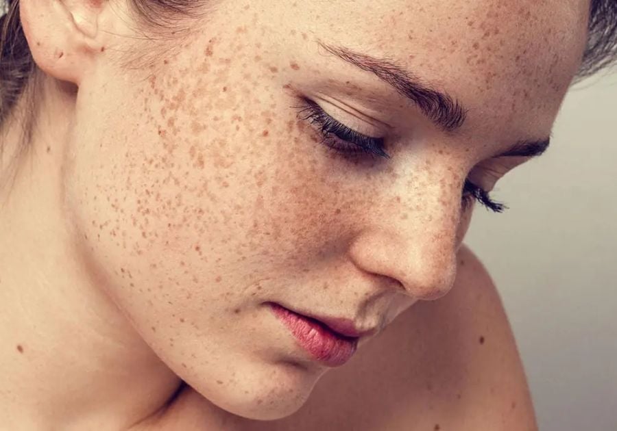 Nám thượng bì là dạng nám xuất hiện ngay trên bề mặt da với đường viền khá rõ ràng và có màu nâu đậm.