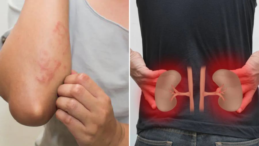 Cảnh báo dấu hiệu suy thận