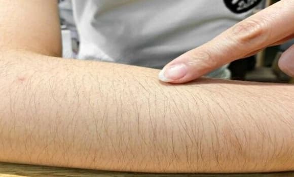 Nhiều phụ nữ cảm thấy mất tự tin khi mặc váy ngắn vì lông chân rậm.