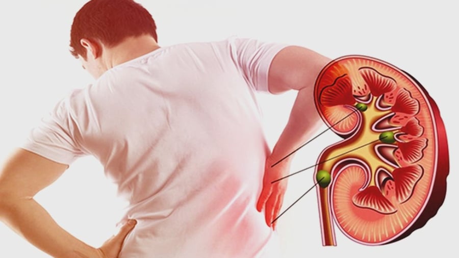 5 dấu hiệu cảnh báo suy thận sớm, nhiều người chủ quan phải chạy thận cả đời