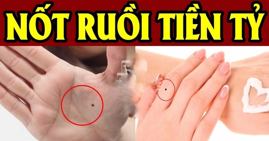 5 nốt ruồi trên tay Ăn May Cả Đời, có 1/5 cũng sướng