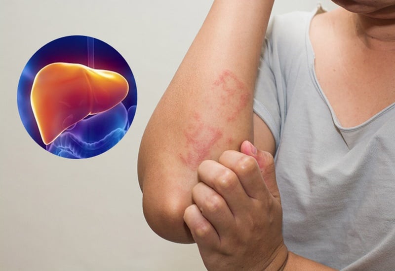 Ngứa không rõ nguyên nhân có thể gan bạn đang suy yếu