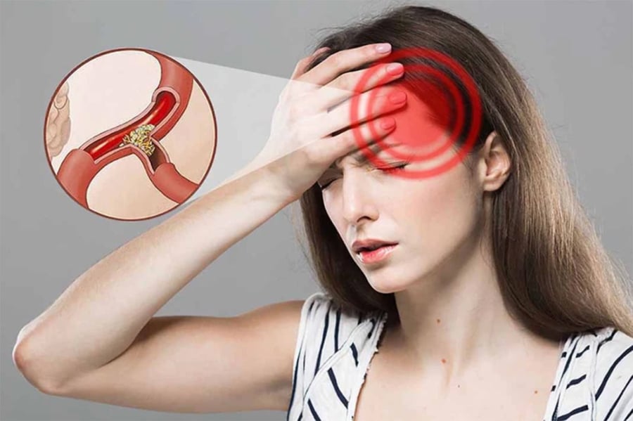 Tình trạng thiếu máu lên não nghiêm trọng có thể dẫn đến đột quỵ. (Ảnh minh họa)