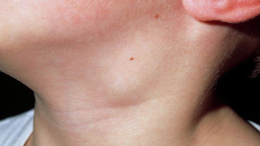 noi_hach_o_co_ben_trai_la_gi_nguyen_nhan_va_cach_xu_ly_4_615de07c06