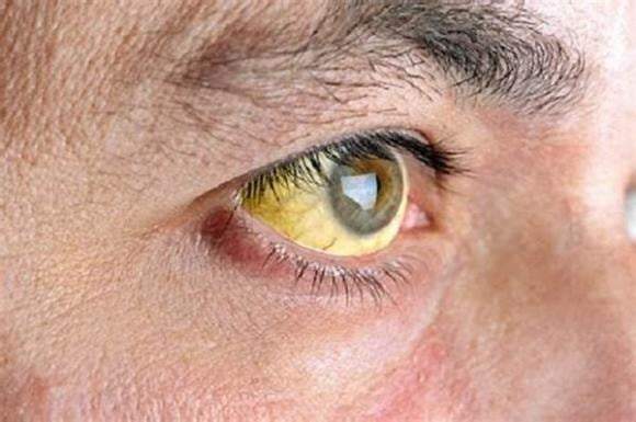 Theo thời gian, màu sắc có thể sẫm hơn đôi chút, tuy nhiên nếu lòng trắng mắt bất ngờ chuyển sang vàng và kèm theo hiện tượng da vàng dần, đây có thể là dấu hiệu cho thấy chức năng gan đang gặp vấn đề, chẳng hạn như viêm gan hoặc xơ gan.