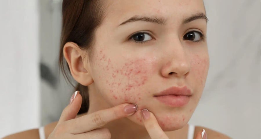 Thâm mụn sẽ khó cải thiện nếu bên trong da vẫn còn sót nhân mụn. 