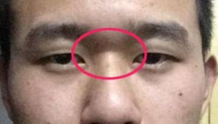 Đường cắt ngang gốc mũi. (Ảnh minh họa)