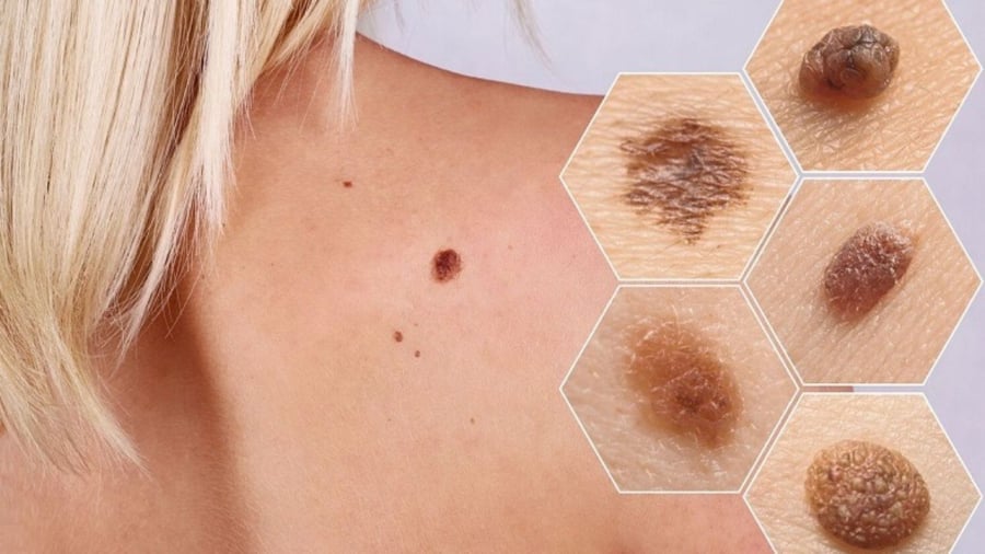 Ung thư da nếu được phát hiện sớm thì khả năng điều trị khỏi rất cao.