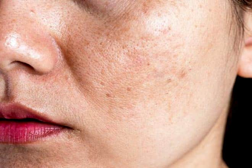 Khi đủ ẩm, làn da trở nên mềm mại, dễ hấp thụ dưỡng chất và cải thiện sắc tố hiệu quả hơn.