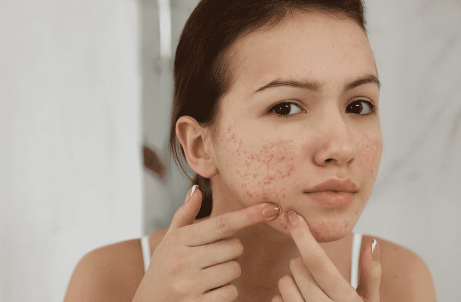 Mục tiêu thực tế của các phương pháp điều trị là làm giảm độ sâu của sẹo, cải thiện kết cấu và giúp bề mặt da trở nên mịn hơn.