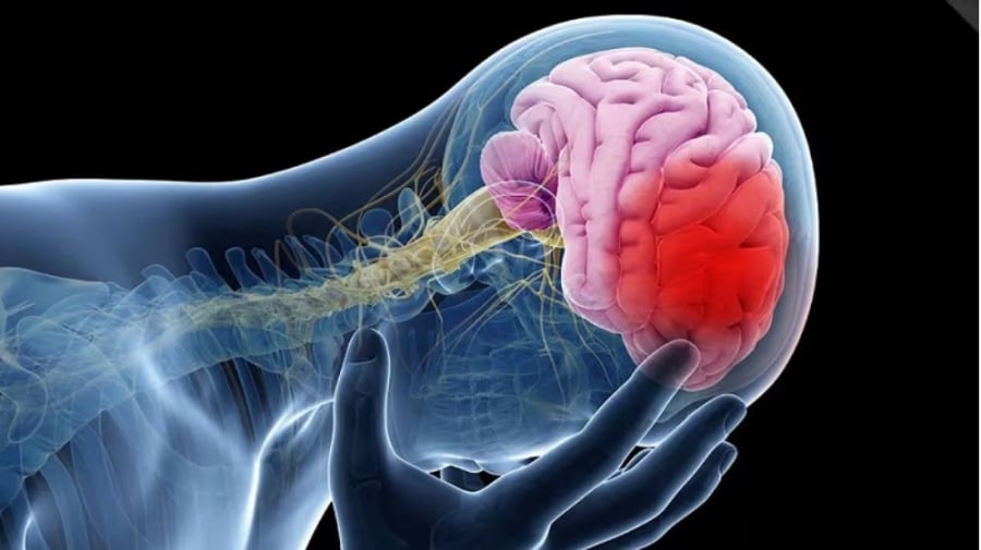 Một trong những biểu hiện thường gặp là tình trạng tê bì, yếu liệt một bên tay, chân hoặc mặt khi đang ngủ hoặc lúc vừa thức giấc. Ảnh minh họa