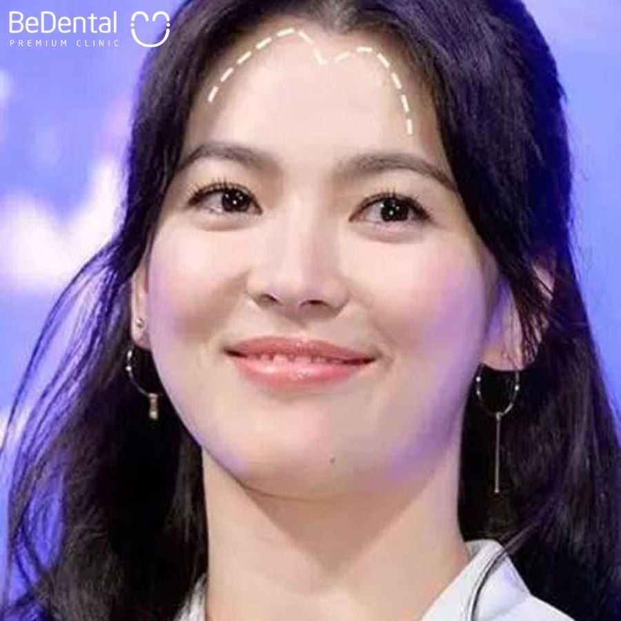 Người có trán chữ M. (Ảnh minh họa)