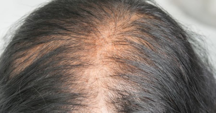 Theo các chuyên gia, một người bình thường có thể rụng khoảng 100–150 sợi tóc mỗi ngày. Đây là quá trình tự nhiên trong chu kỳ phát triển của tóc nên không đáng lo ngại.    