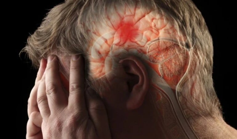 Nhiều nghiên cứu lâm sàng chỉ ra rằng khoảng 60% bệnh nhân xuất hiện các dấu hiệu bất thường từ 7–30 ngày trước khi nhồi máu não xảy ra:    