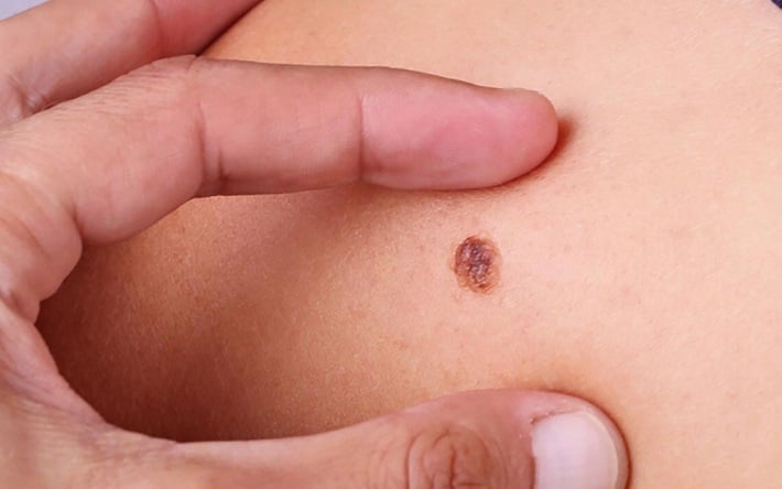 Ngoài ung thư da, một số loại ung thư khác cũng có thể gây biến đổi da như sạm màu, vàng da vàng mắt, nổi ban đỏ, bong tróc hoặc ngứa kéo dài.