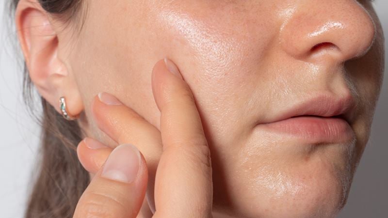 Khi nhiệt độ tăng cao, tuyến bã nhờn hoạt động mạnh hơn, khiến da dễ rơi vào trạng thái dư dầu và mất cân bằng. 