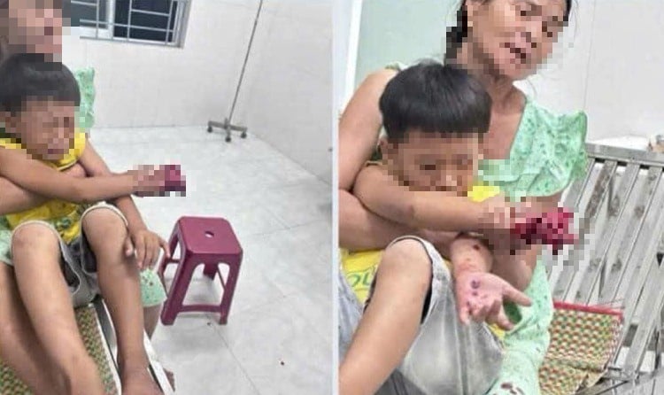 Ngày 29-4, Bệnh viện Đà Nẵng xác nhận đang tiếp nhận và điều trị cho một bệnh nhi bị thương nặng ở bàn tay phải, nghi do điện thoại phát nổ trong lúc sử dụng.    