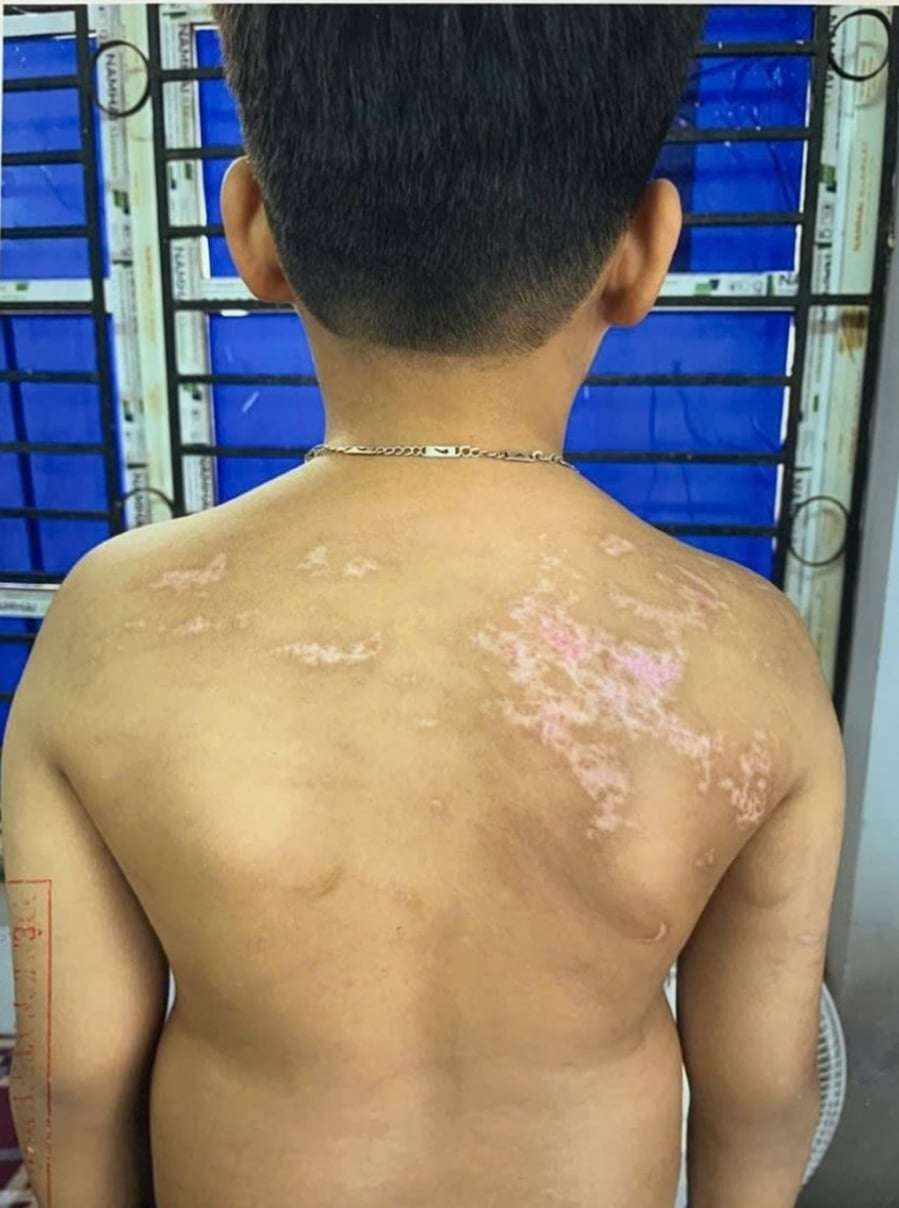 Sau sự việc, Chung phát hiện các vết thương trên cơ thể con nhưng chỉ dùng tinh dầu xịt lên vết thương rồi để cháu đi ngủ. Vụ việc sau đó được cơ quan chức năng vào cuộc điều tra, xử lý theo quy định pháp luật.    
