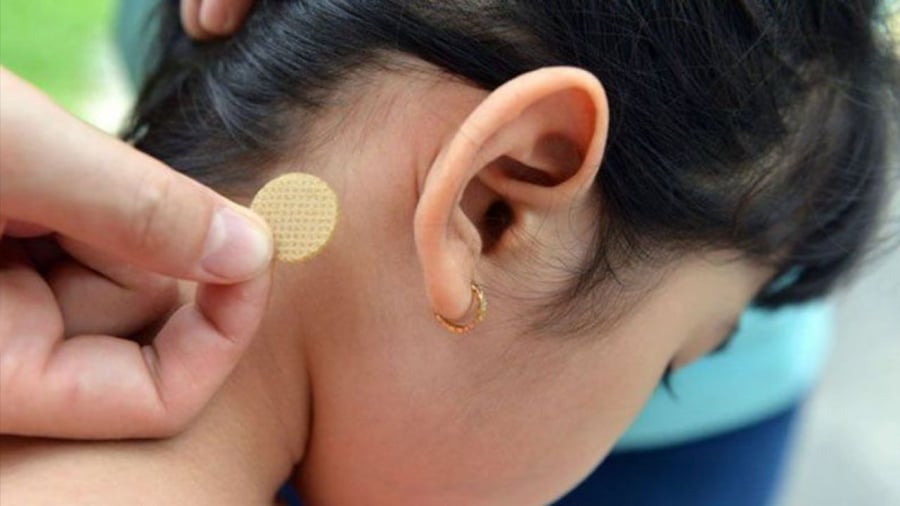 Bé gái 7 tuổi xuất hiện các biểu hiện bất thường do sử dụng miếng dán chống say tàu xe không đúng liều.