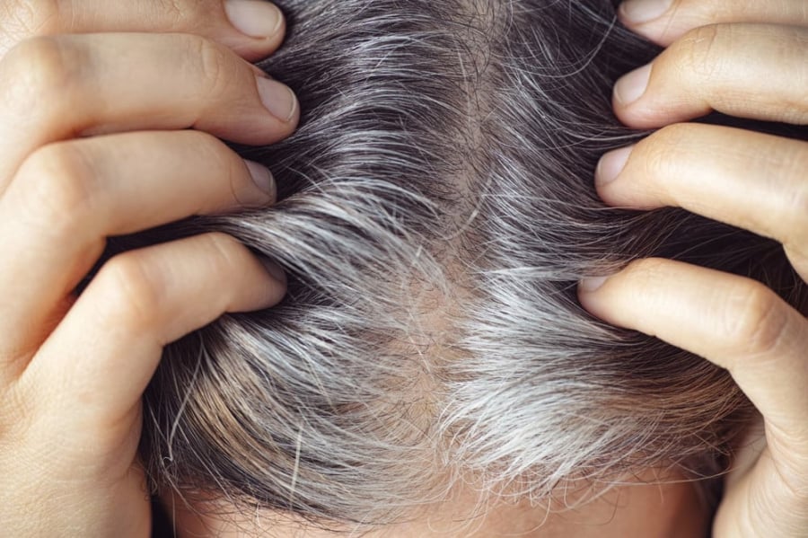 Nhiều chuyên gia cho rằng thiếu biotin có thể khiến tóc yếu và dễ rụng hơn.