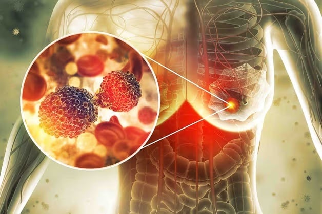 “Thủ phạm” gây K tuyến vú nhiều nhất ở phụ nữ