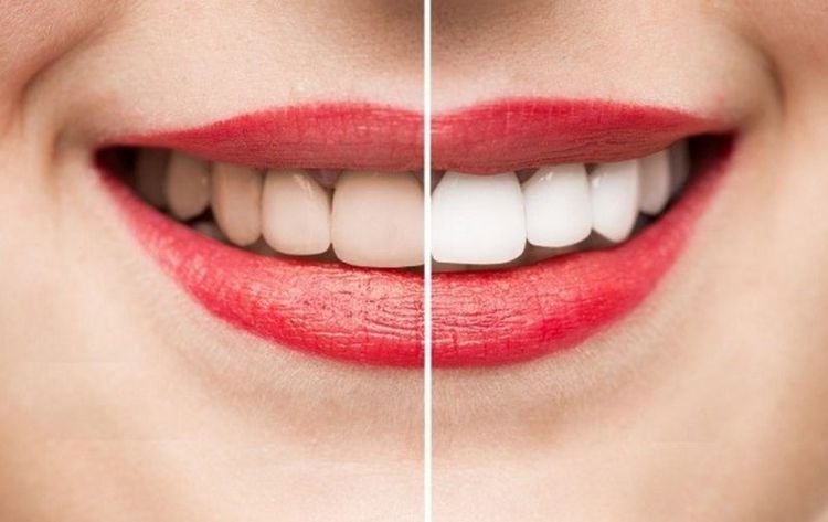 Ngoài ra, tình trạng khô miệng còn khiến hơi thở kém tươi mát và làm men răng dễ bị tác động bởi axit trong thực phẩm hằng ngày.    