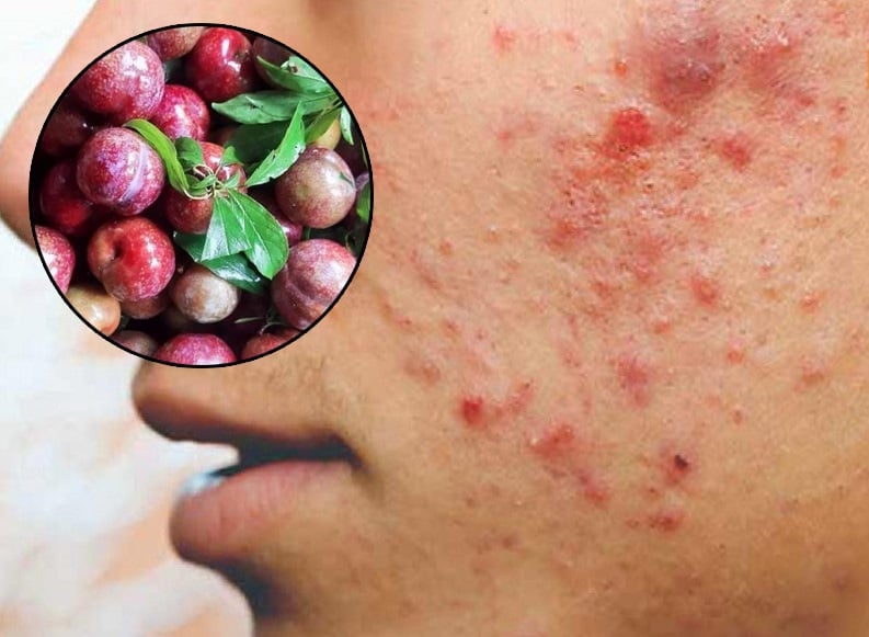3 đối tượng không được ăn mận: Dễ nổi mụn, nóng trong
