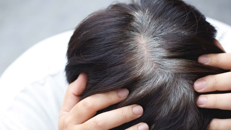Tóc bạc sớm không chỉ liên quan đến vấn đề lão hóa mà còn có thể phản ánh một số vấn đề về sức khỏe.