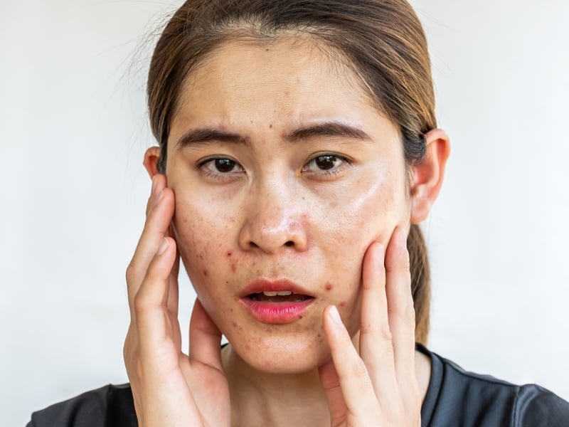 Không ít người cho rằng sử dụng càng nhiều sản phẩm thì hiệu quả kiểm soát dầu và trị mụn càng tốt. 