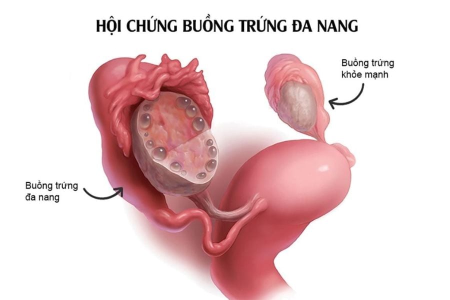 hoi-chung-buong-trung-da-nang-anh-huong-noi-tiet-phu-nu