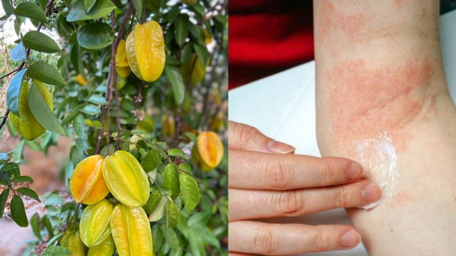 Lá khế được dân gian dùng để trị rôm sảy