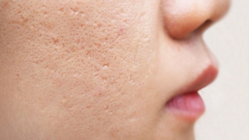 Sẹo mụn xuất hiện khi quá trình viêm do mụn gây tổn thương đến collagen và các mô nâng đỡ dưới da. 