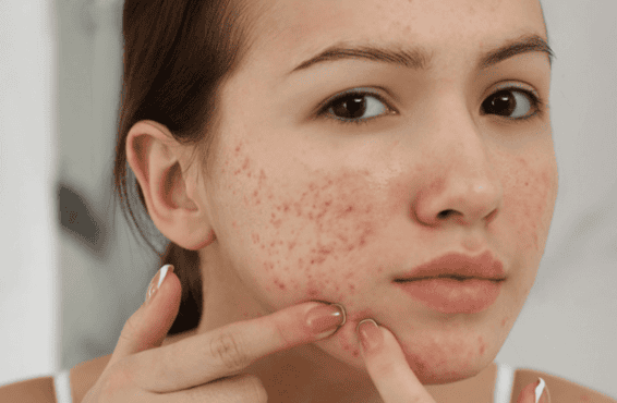 BHA, hay còn gọi là axit salicylic, là thành phần quen thuộc trong các sản phẩm dành cho da dầu và da dễ nổi mụn. 