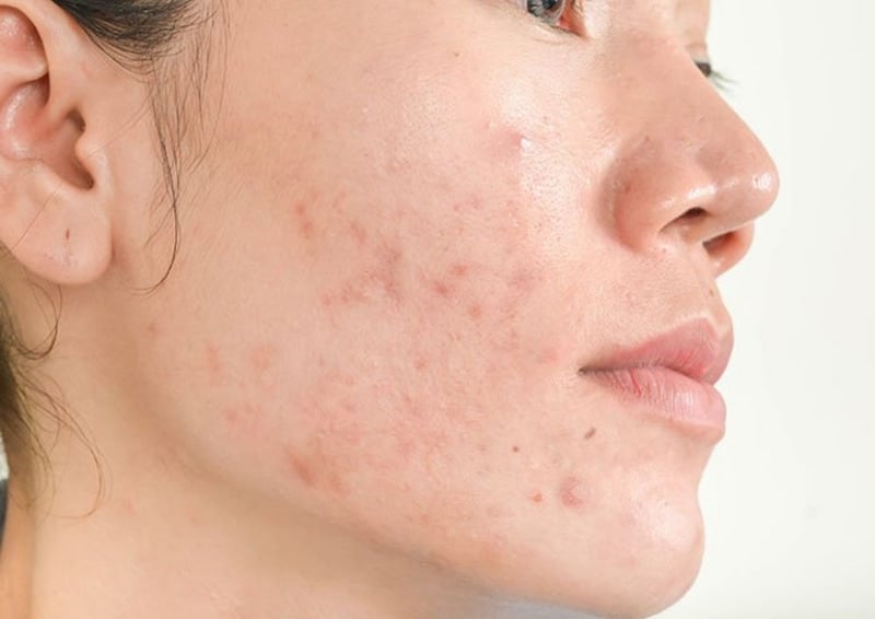 Các dẫn xuất vitamin A như adapalene được đánh giá cao trong việc ngăn ngừa mụn tái phát